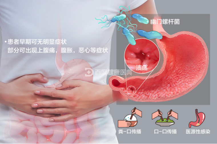 一文全面了解幽门螺旋杆菌