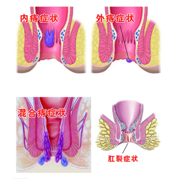 昆明肛肠疾病检查医院-电子肛门镜检查