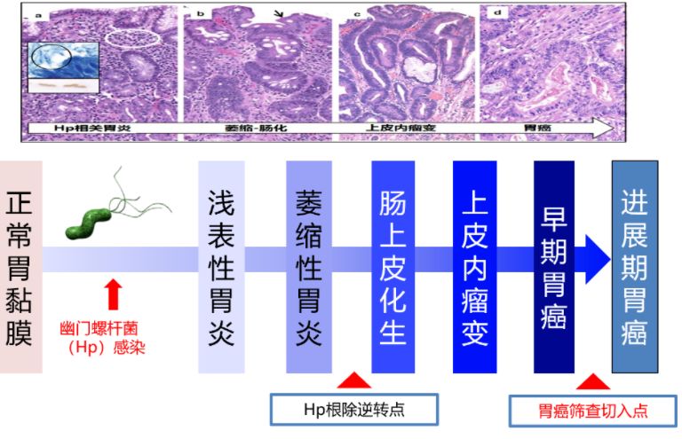 胃癌,大部分都是拖出来的?这些胃病需及时治疗!