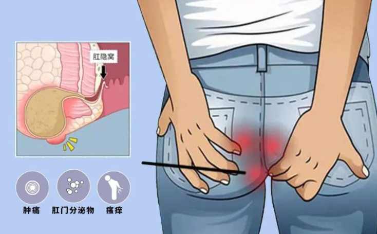 肛周脓肿拖不得!当心肛瘘紧随其后!