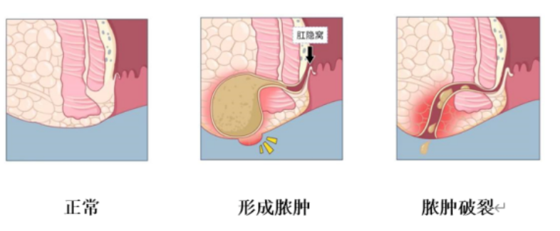 屁屁上红肿长包?小心肛周脓肿,千万别拖延,应尽快就医!